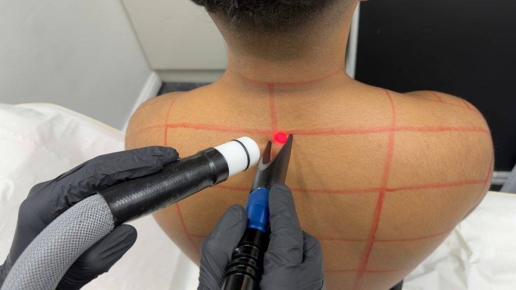 Back and shoulders laser hair removal _