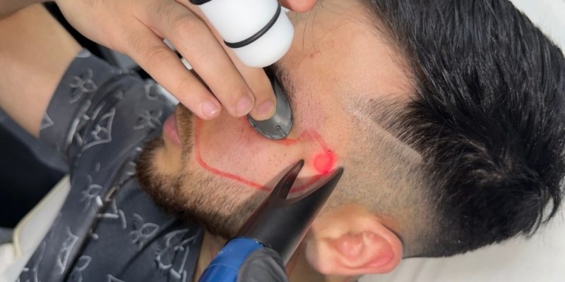 Why Asian and Middle Eastern Skin Tones Thrive with NDYAG Laser